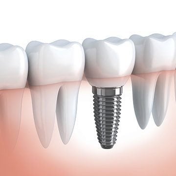 Dental Implants for missing teeth in Jacksonville FL