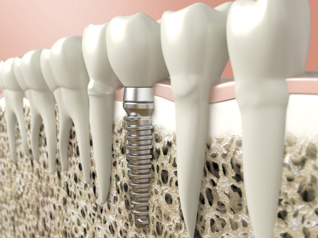 Restore Your Smile with Dental Implants