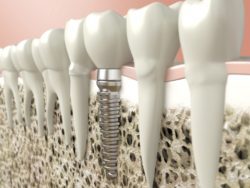 Restore Your Smile with Dental Implants