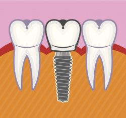 dental implant diagram