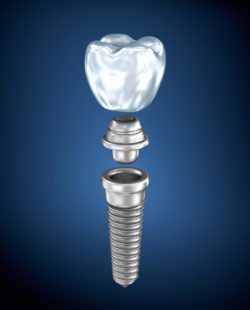  Affordable Dental Implant Restorations Near Me in Jacksonville, Florida thumbnail