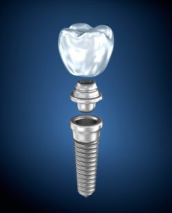 dental implant for missing teeth in Jacksonville Florida