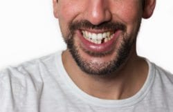 Replacing missing teeth in Jacksonville FL