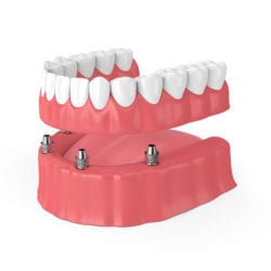 All-on-four dental implants for dentures