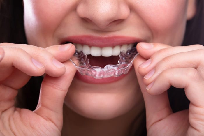 Invisalign In Jacksonville Florida