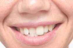 zoomed and cropped image of a smile with crooked teeth - top incisor is sitting behind the bottom incisors crooked teeth cosmetic dentistry dentist in Jacksonville Florida