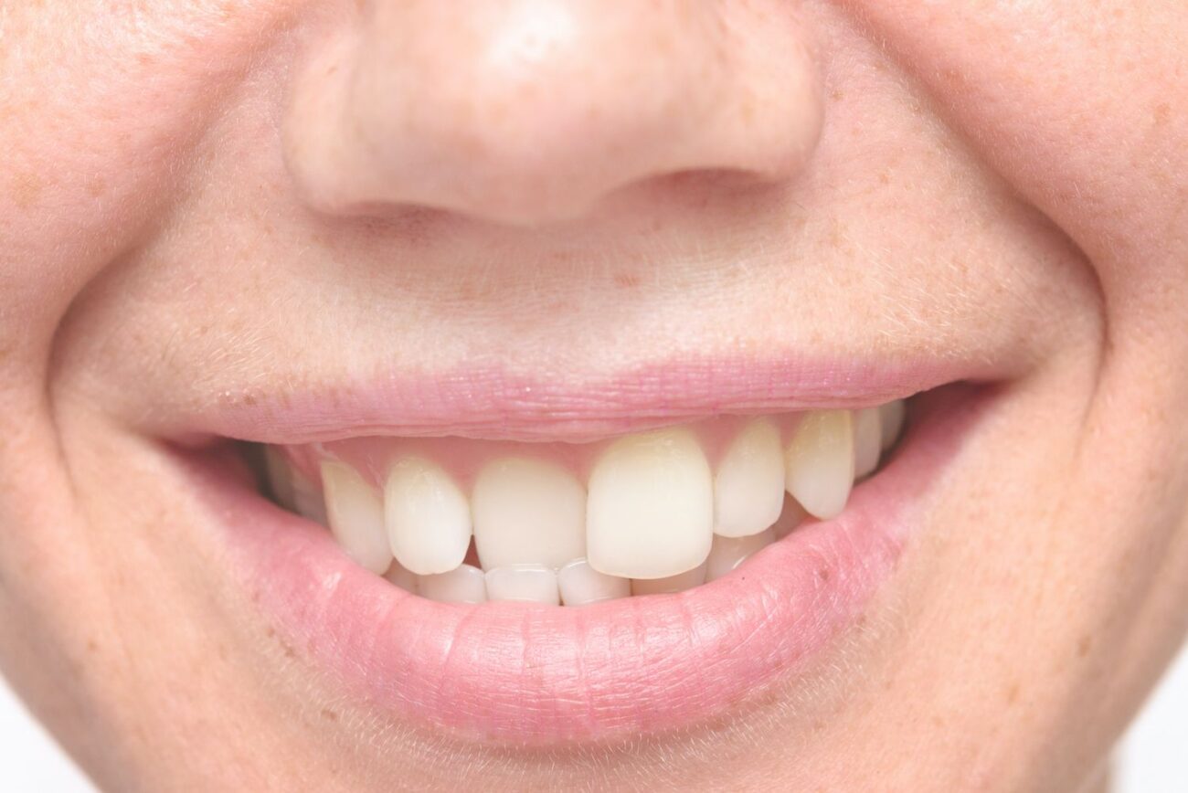 zoomed and cropped image of a smile with crooked teeth - top incisor is sitting behind the bottom incisors crooked teeth cosmetic dentistry dentist in Jacksonville Florida