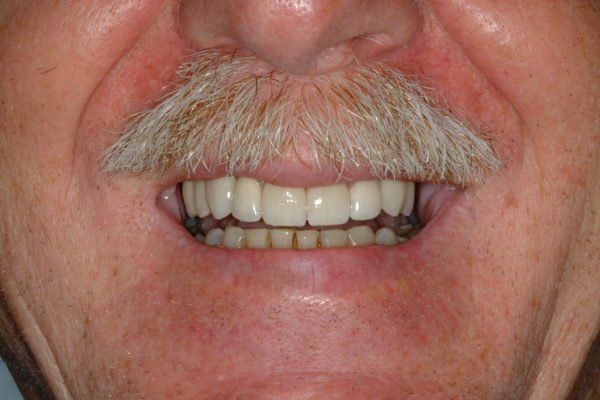 Cecil-B-After-Smile-600x400