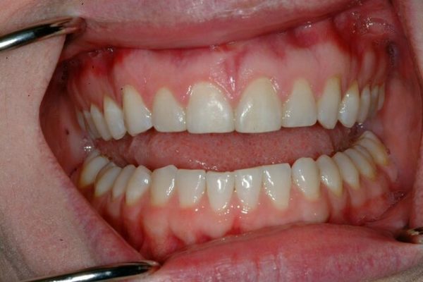Corey-W-After-Smile_preview-600x400