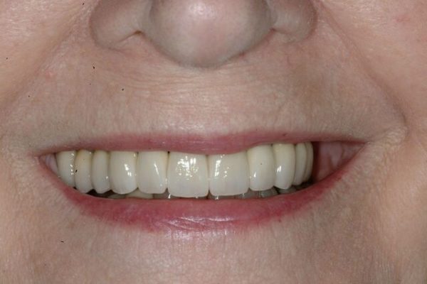 Joyce-C-After-Smile_preview-600x400