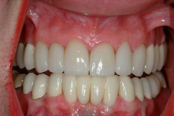 Joyce-P-After-Smile_preview-600x400