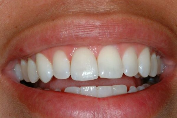 Patient-1-After-Smile_preview-600x400