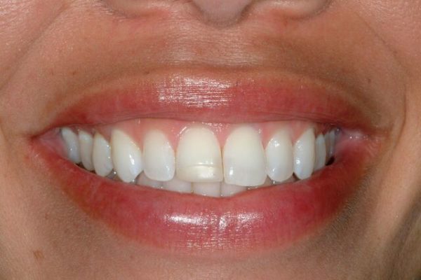Patient-1-Before-Smile_preview-600x400