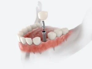 What to Expect with Dental Implants in Jacksonville, FL