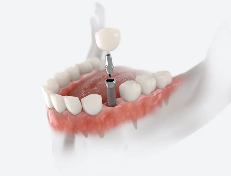 What to Expect with Dental Implants in Jacksonville, FL