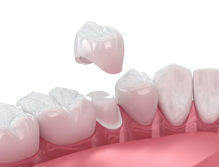 Same-Day Crowns vs. Traditional Crowns in Jacksonville, FL